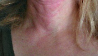 6 Habits that Trigger Itchy Skin on Neck - 34 Menopause ...